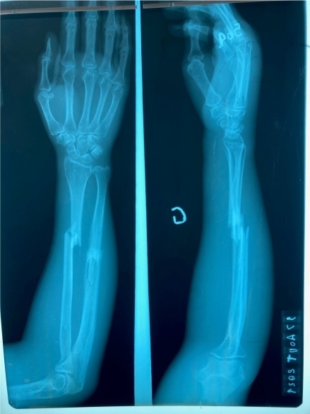 Two xrays of broken arms